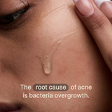 Acne Phage Serum by Phyla Skincare