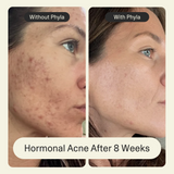 Acne Phage Serum by Phyla Skincare