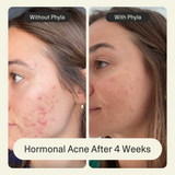 Acne Phage Serum by Phyla Skincare