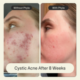 Acne Phage Serum by Phyla Skincare