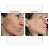 Acne Phage System by Phyla Skincare